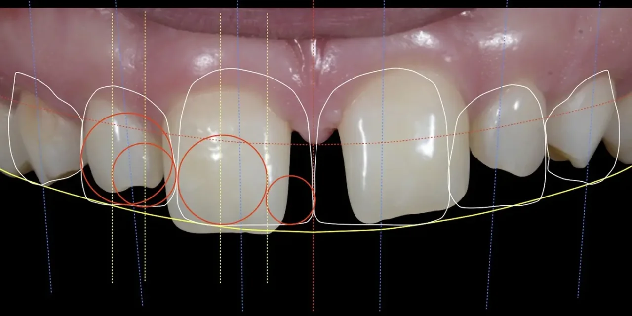 Na czym polega cyfrowe projektowanie uśmiechu?