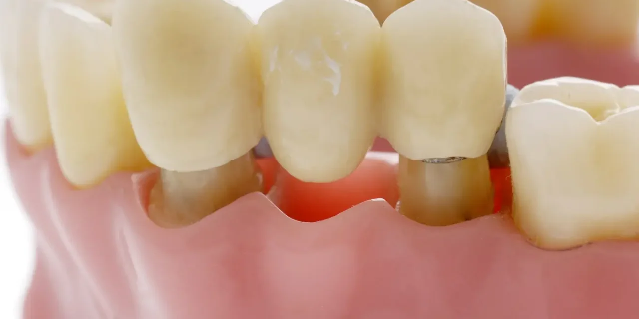Czym są mosty zębowe i jak o nie dbać? Po czym poznać, że coś jest nie tak z mostem?